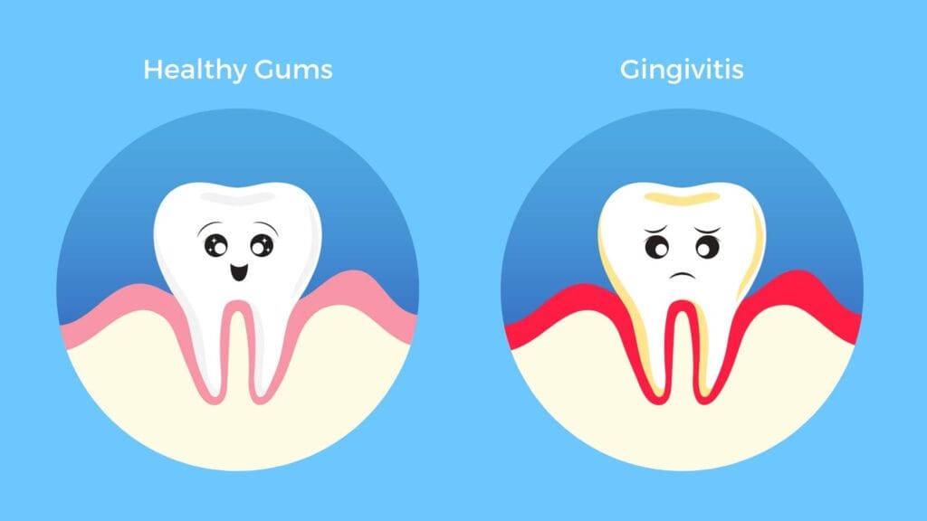 Gum Bleeding